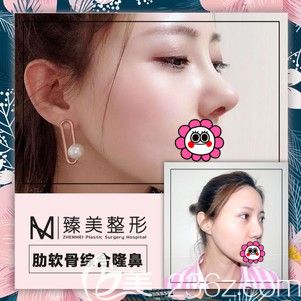 哈爾濱臻美肋軟骨隆鼻對比效果