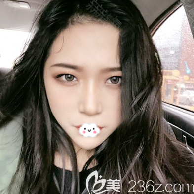 深圳美萊做鼻翼縮小手術(shù)效果怎么樣
