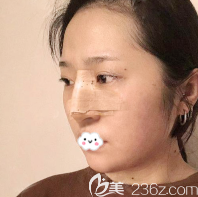 深圳美萊鼻翼縮小案例術(shù)后兩天效果圖