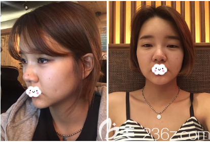 在韓國id整形醫(yī)院做雙顎手術(shù)術(shù)前照片 在韓國id整形醫(yī)院做雙顎手術(shù)術(shù)前照片