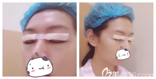 剛做完切開重瞼+上瞼下垂矯正