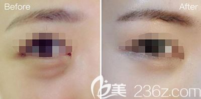 韓國bonps整形外科眼部整形照片