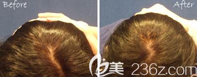 韓國bonps整形外科骨水泥填充后腦勺圖片