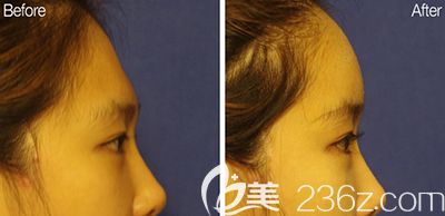 韓國bonps整形外科額頭填充照片