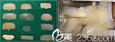 頭部修復(fù)手術(shù)取出的硅膠假體示意圖