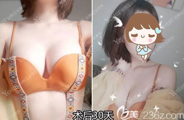 麥格假體豐胸手術(shù)一個月摸著柔軟多了