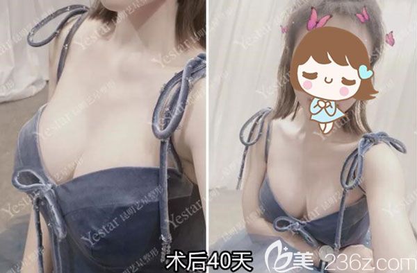 假體豐胸術(shù)后40天縫合也特別精細小巧，幾乎看不出來