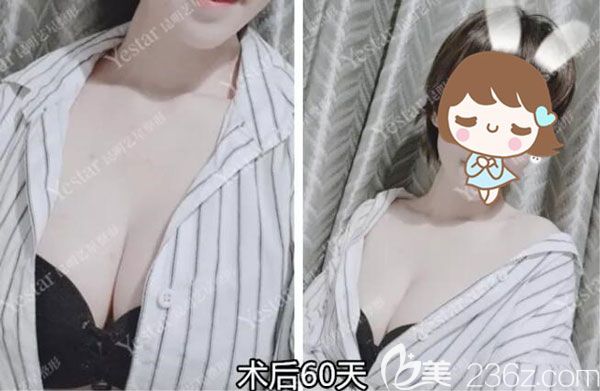 談?wù)勎以诶ッ魉囆钦倚焱鳆湼窦袤w豐胸295CC真實感受及術(shù)后恢復(fù)效果