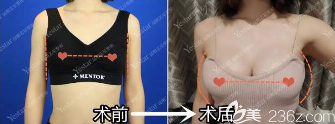 麥格假體豐胸一年后前后效果對比圖