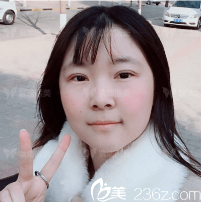 劉文峰醫(yī)生給我做眼綜合第7天效果 劉文峰醫(yī)生給我做眼綜合第7天效果