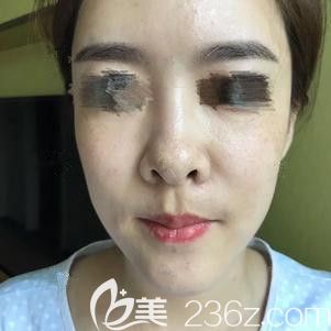 在唐山蘇亞美聯(lián)臣做隆鼻修復(fù)術(shù)前鼻子寬大 在唐山蘇亞美聯(lián)臣做隆鼻修復(fù)術(shù)前鼻子寬大