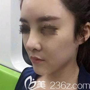 經(jīng)過一次玻尿酸隆鼻失敗后我選擇李春雷醫(yī)生做硅膠隆鼻手術進行修復 還為大家?guī)硖粕教K亞美聯(lián)臣鼻部整形價格表