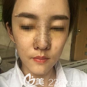 李春雷醫(yī)生為我剛做完隆鼻失敗修復(fù)術(shù)后鼻子微腫 李春雷醫(yī)生為我剛做完隆鼻失敗修復(fù)術(shù)后鼻子微腫
