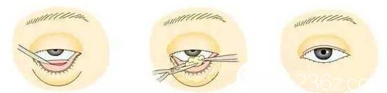 內(nèi)切法祛眼袋