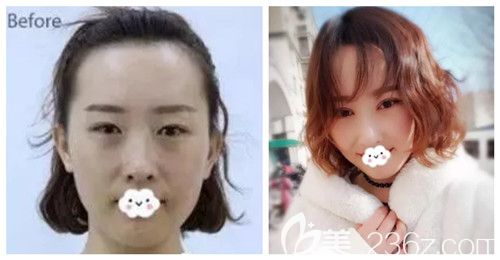 唐山蘇亞美聯(lián)臣做雙眼皮案例