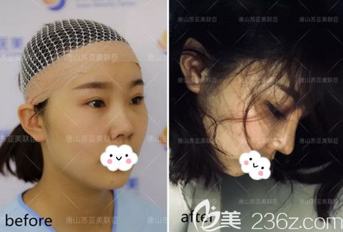 唐山蘇亞美聯(lián)臣暑期整形優(yōu)惠價(jià)格表?yè)屜瓤?硅膠隆鼻和雙眼皮均為699元