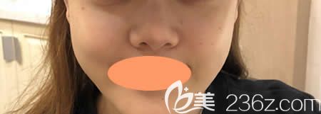 找景德鎮(zhèn)圣嘉麗林麗德做了膨體+肋軟骨隆鼻綜合術(shù)前 找景德鎮(zhèn)圣嘉麗林麗德做了膨體+肋軟骨隆鼻綜合術(shù)前