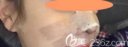 找景德鎮(zhèn)圣嘉麗林麗德做了膨體+肋軟骨隆鼻綜合術(shù)即刻效果圖 找景德鎮(zhèn)圣嘉麗林麗德做了膨體+肋軟骨隆鼻綜合術(shù)即刻效果圖