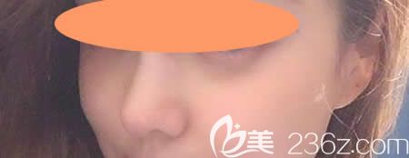 找景德鎮(zhèn)圣嘉麗林麗德做了膨體+肋軟骨隆鼻綜合術(shù)第48天 找景德鎮(zhèn)圣嘉麗林麗德做了膨體+肋軟骨隆鼻綜合術(shù)第48天