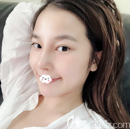 隆鼻失敗修復術(shù)后9天拆線效果圖 隆鼻失敗修復術(shù)后9天拆線效果圖