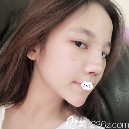 找深圳美萊梁志為做隆鼻修復第六天恢復效果 找深圳美萊梁志為做隆鼻修復第六天恢復效果