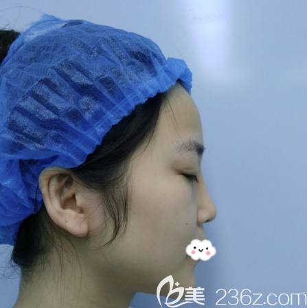 在深圳美萊做隆鼻修復術(shù)前照片 在深圳美萊做隆鼻修復術(shù)前照片