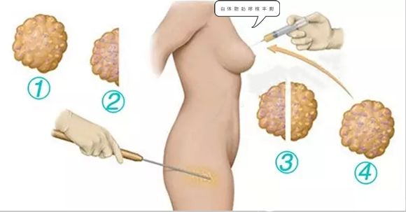 做自體脂肪隆胸一定要選擇正規(guī)的整形機(jī)構(gòu)和經(jīng)驗(yàn)豐富的整形醫(yī)生