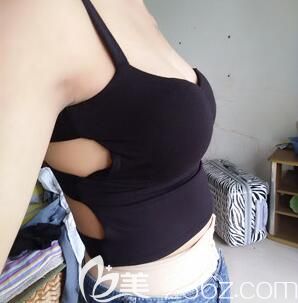 我在南寧華美整形做完吸脂豐胸第7天 我在南寧華美整形做完吸脂豐胸第7天