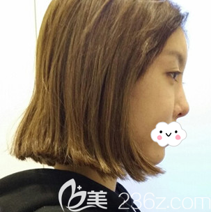 鼻綜合術(shù)前側(cè)面照