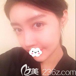 韓國普羅菲耳（profile）整形醫(yī)院李好基鼻綜合效果