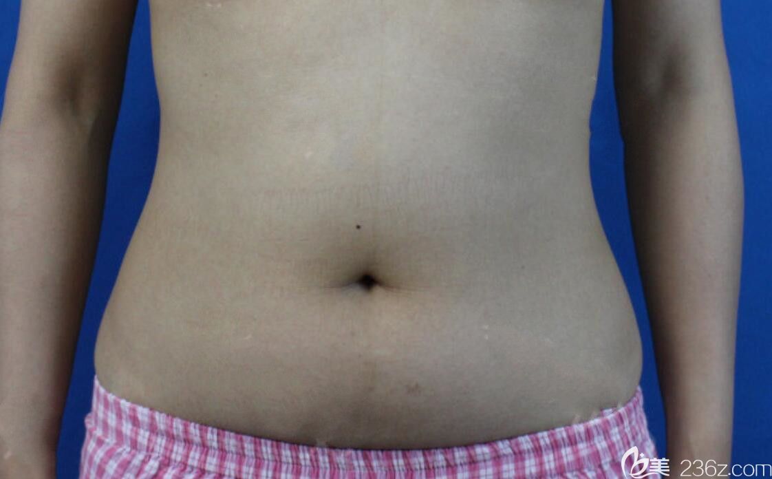 找安徽合肥韓美整形劉冷做腰腹環(huán)吸前 找安徽合肥韓美整形劉冷做腰腹環(huán)吸前