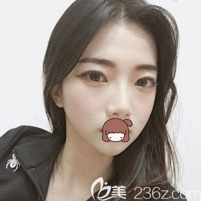 在韓國純真做眼鼻綜合手術后半個月 在韓國純真做眼鼻綜合手術后半個月