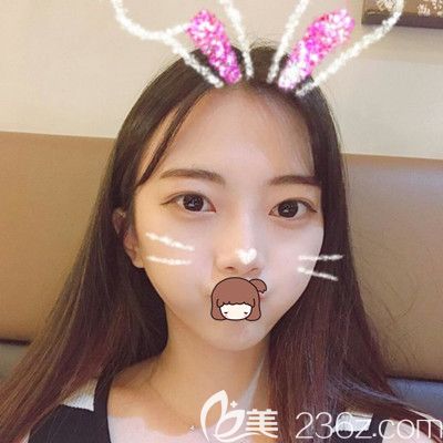 在韓國純真做眼鼻綜合手術后2個月 在韓國純真做眼鼻綜合手術后2個月