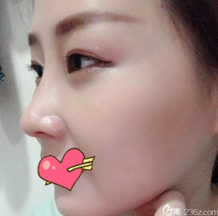 華美整形隆鼻失敗修復(fù)術(shù)后16天恢復(fù)情況 華美整形隆鼻失敗修復(fù)術(shù)后16天恢復(fù)情況