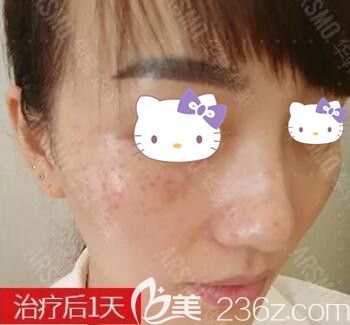皮秒祛雀斑術(shù)后第1天效果情況