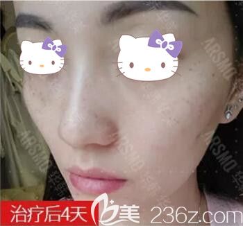 在華韓華美做皮秒祛雀斑術(shù)后4天效果