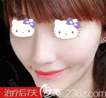 在長沙做皮秒祛雀斑術(shù)后7天情況