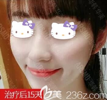 用皮秒治療雀斑術(shù)后15天情況