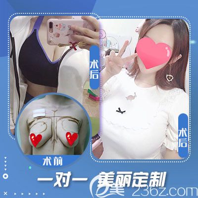 石家莊藍(lán)山做隆胸手術(shù)案例