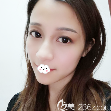 雙眼皮眼綜合術(shù)后15天