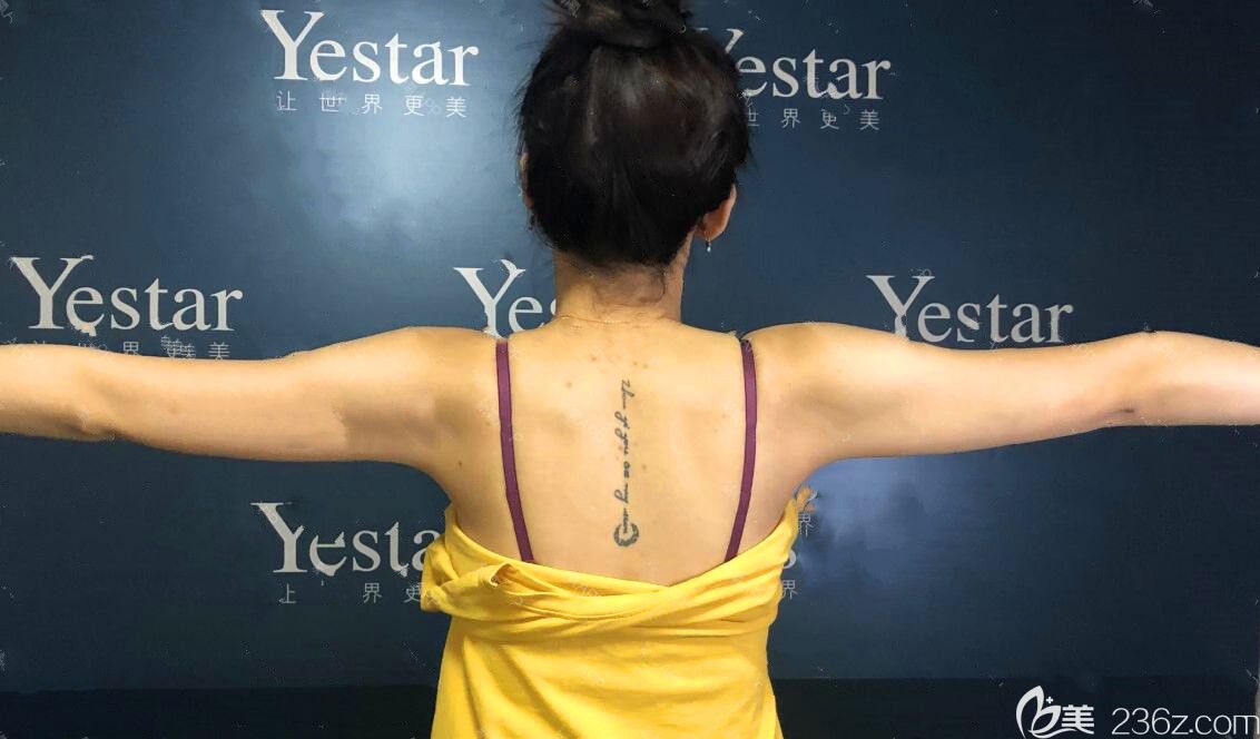 吸脂瘦手臂術(shù)前照 吸脂瘦手臂術(shù)前照