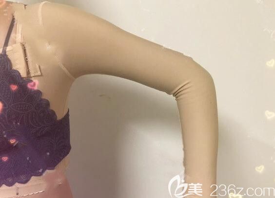 合肥藝星整形手臂吸脂術(shù)后第7天情況 合肥藝星整形手臂吸脂術(shù)后第7天情況