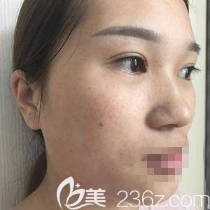 做完后三天的照片 做完后三天的照片