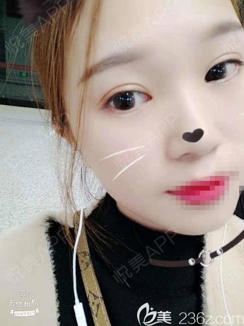 到鄭州醫(yī)德佳體驗了一次超贊的蜂巢皮秒祛斑 效果果真名不虛傳