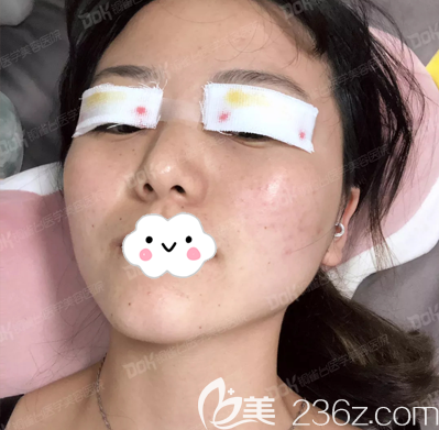 成都銅雀臺雙眼皮術(shù)后即刻照片