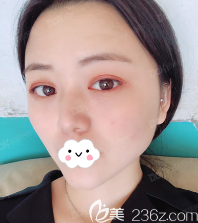 成都銅雀臺劉溪雙眼皮術(shù)后20天照片