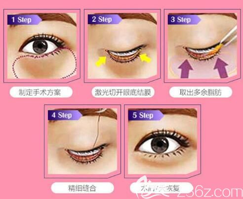 內(nèi)切法祛眼袋