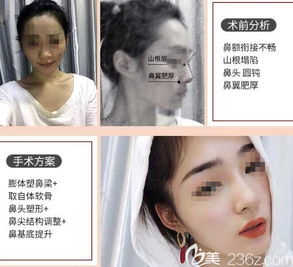 胡斌醫(yī)生肋軟骨隆鼻案例