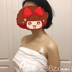 朱勝軍醫(yī)生幫我做自體脂肪隆胸術(shù)后5天胸部飽滿