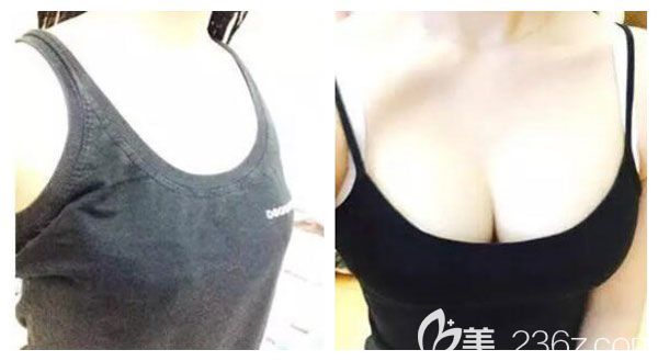 華美美萊自體脂肪豐胸案例效果對比圖